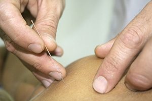 Idris is performing a medical acupuncute treatment
